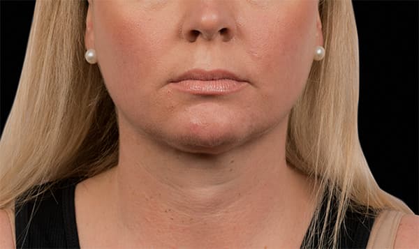 cool-sculpting-after