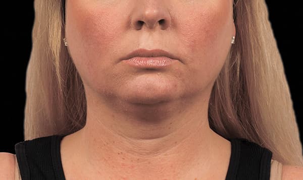 cool-sculpting-chin