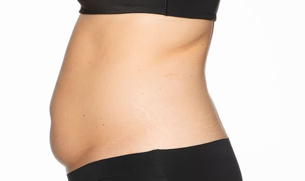 cool-sculpting-london-clinic