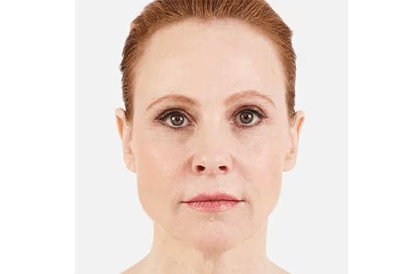 juvederm-before-after-4