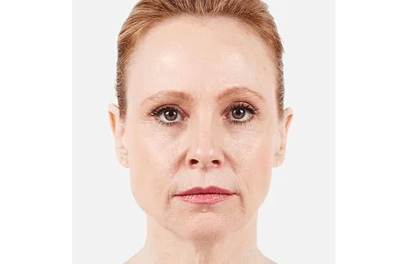 juvederm-before-after-1