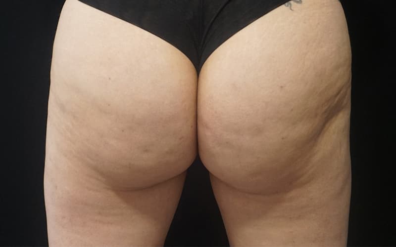 lanluma-bum-before-after-results