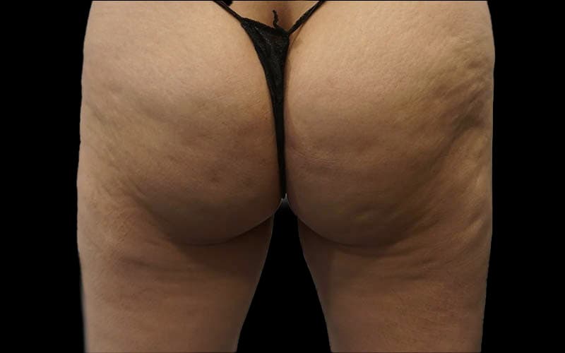 lanluma-bum-before-after-1