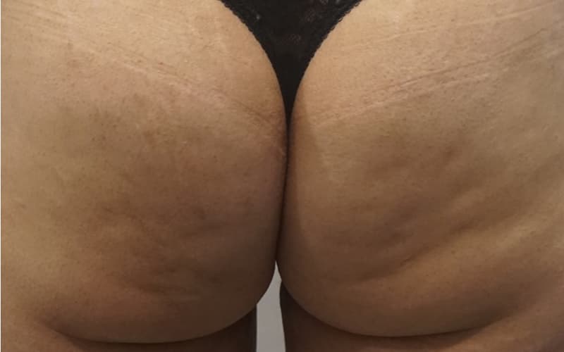 after-cellulite-skinmedical