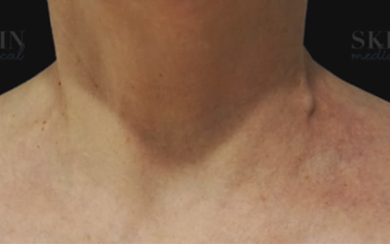 neck-lanluma-after