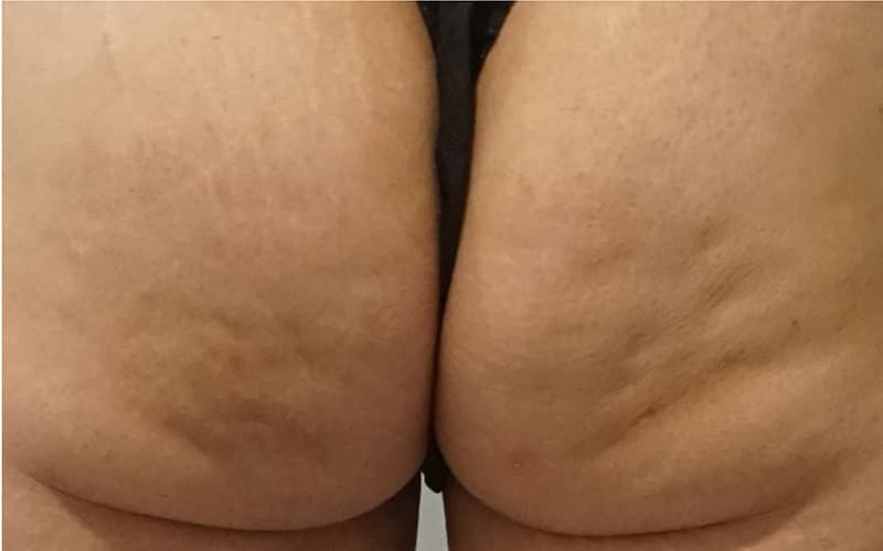 before-cellulite-skinmedical