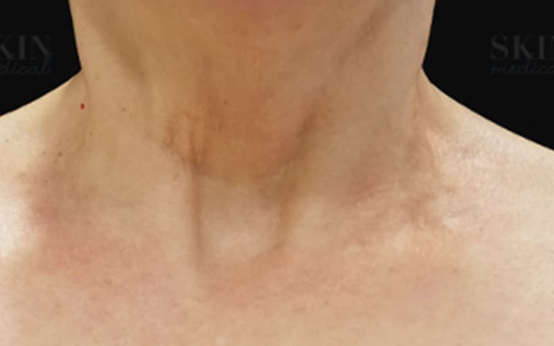 neck-before-after