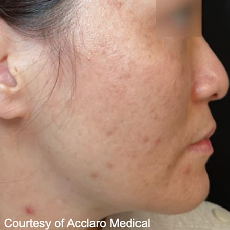 ultraclear-laser-treatment