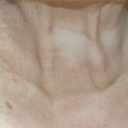 ultraclear-neck-after