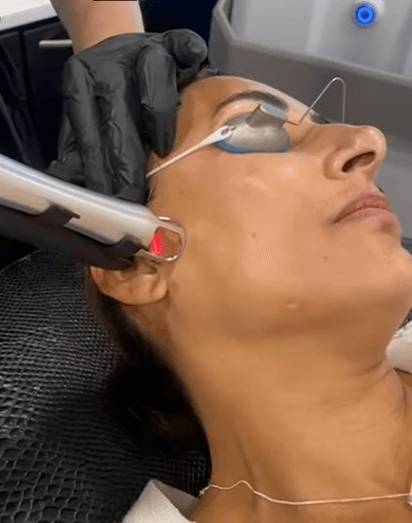 UltraClear-Treatment-SkinMedical