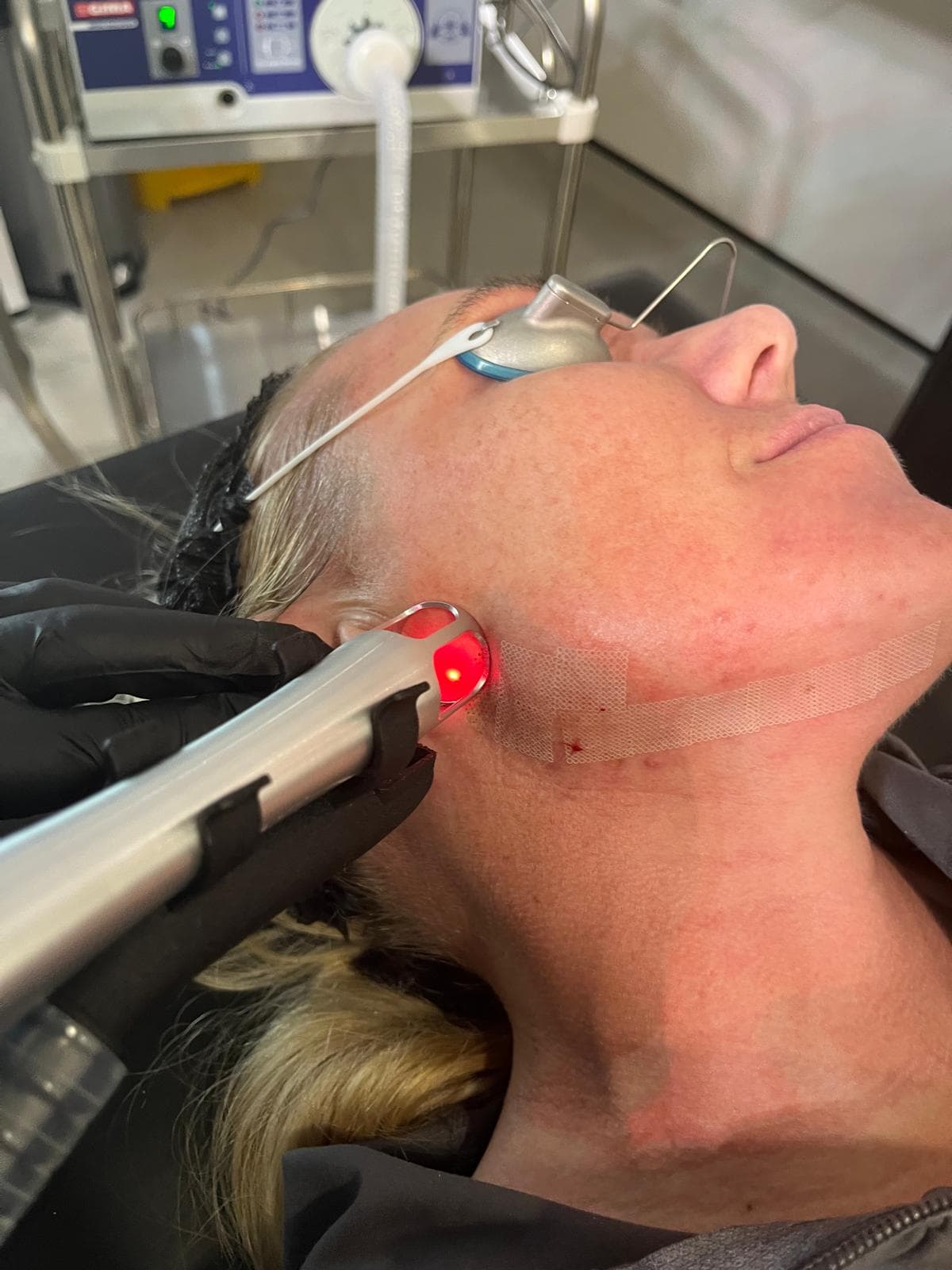 Ultraclear-treatment-london