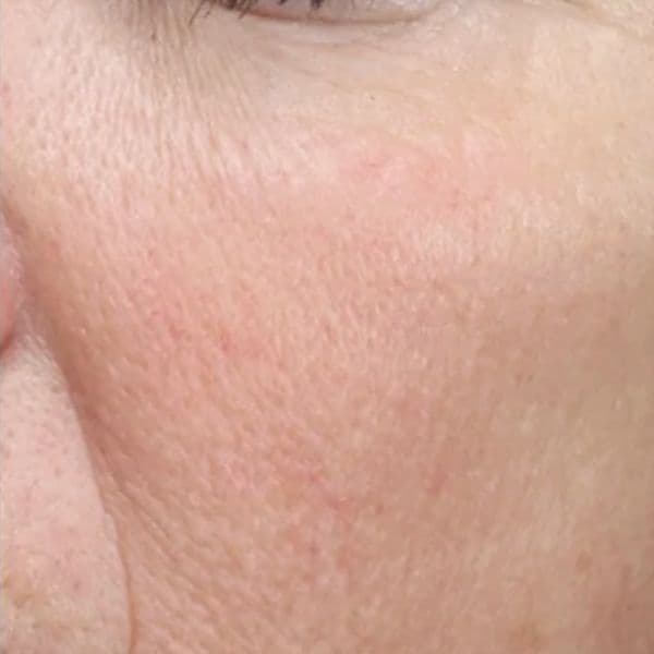 vbeam-after