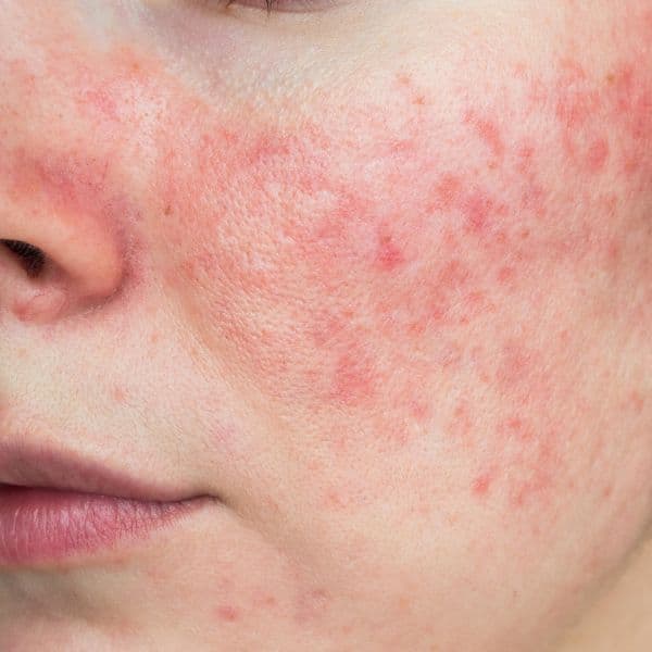 hyperpigmentation-close