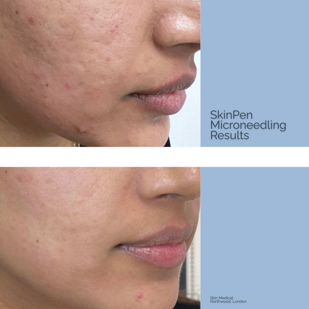 Skin Pen Needling Results by Skin Medical Northwood London