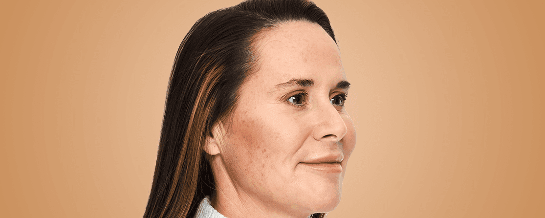 ellanse-filler-treatment