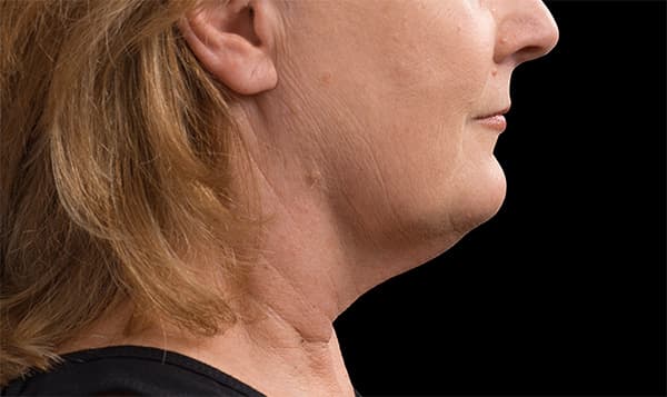 coolsculpting-before-after-chin