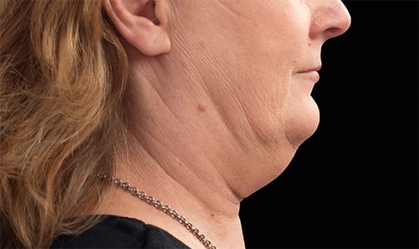 coolsculpting-double-chin