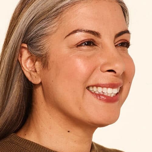 botox-after