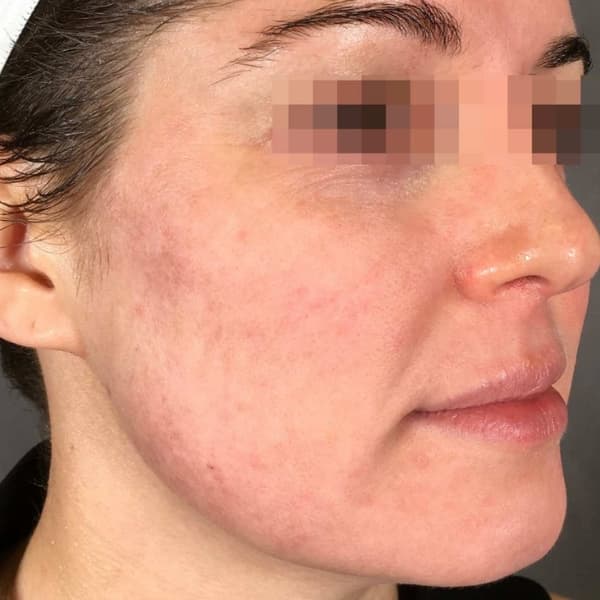 radiofrequency-before