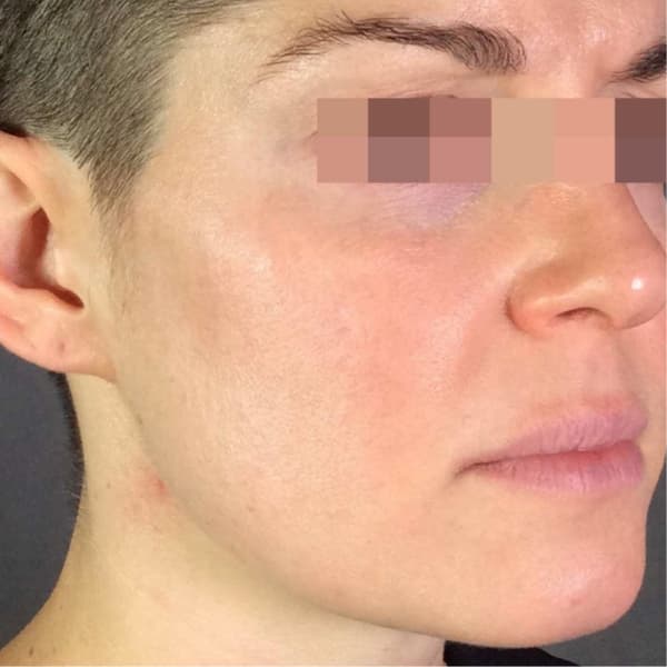 radiofrequency-after