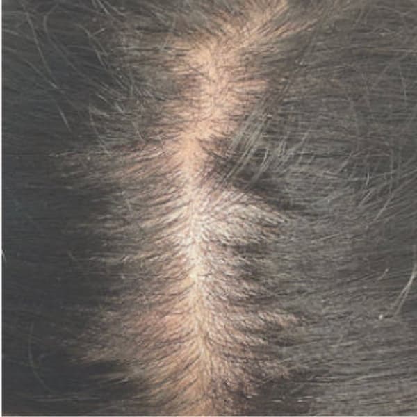 keravive-scalp-before