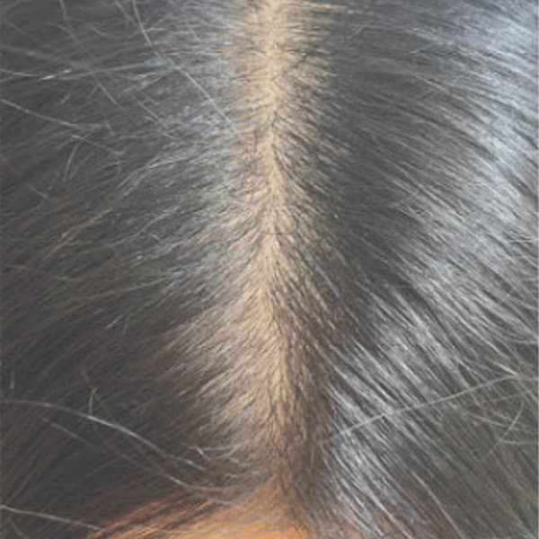 keravive-scalp-after