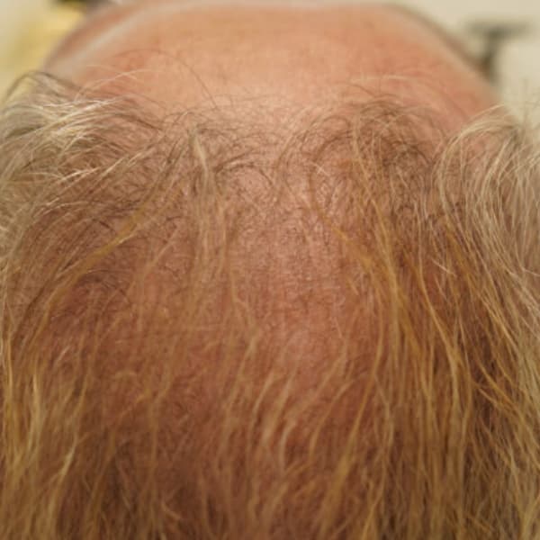 Dutexome-after