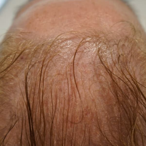 Dutexome-before